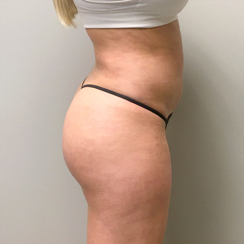 Brazilian Butt Lift 03