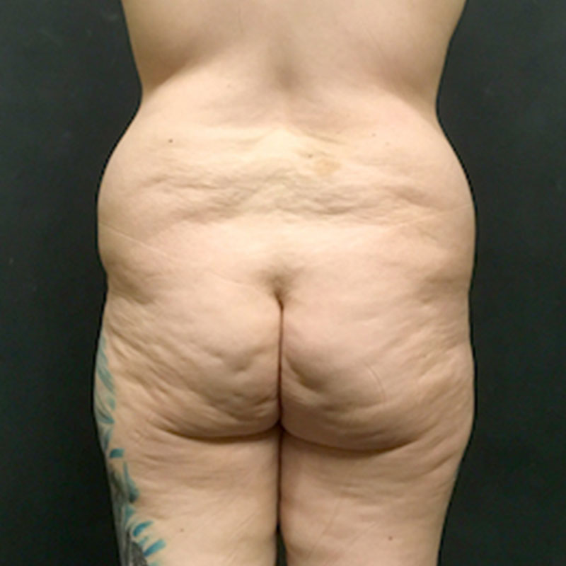 Brazilian Butt Lift 01