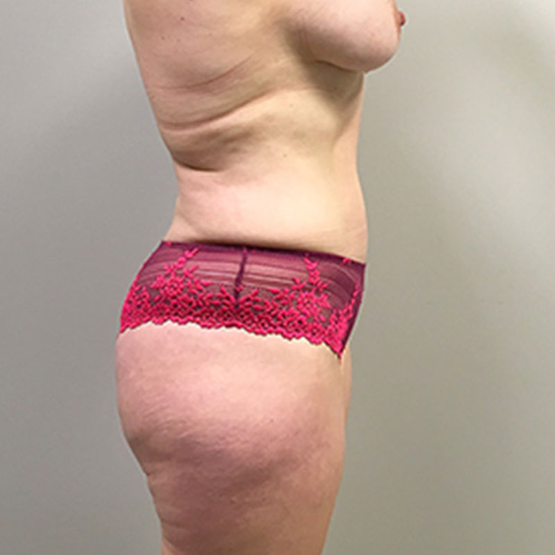 Brazilian Butt Lift 03