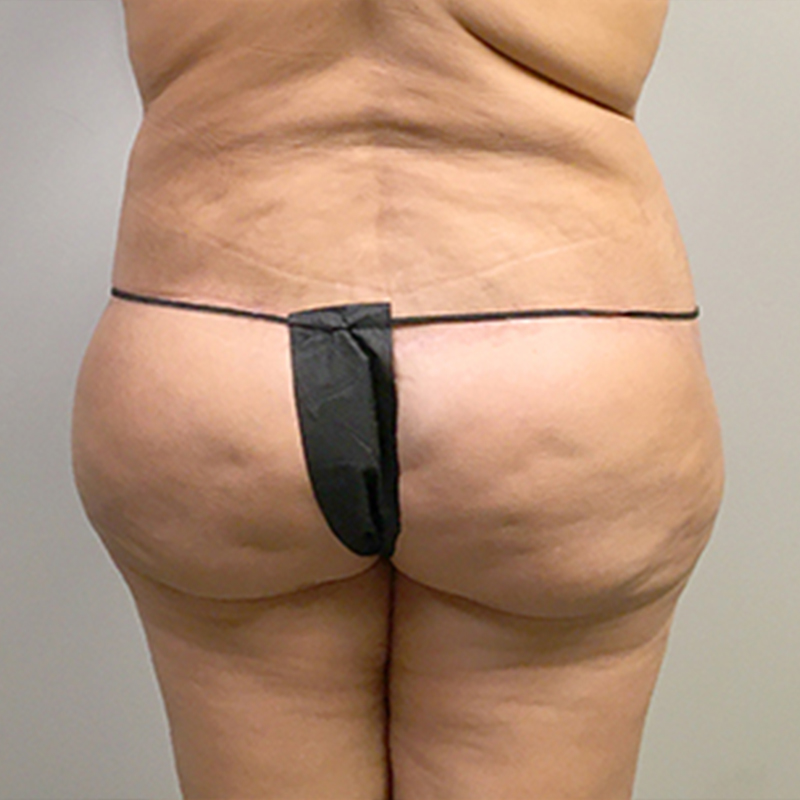 Brazilian Butt Lift 27