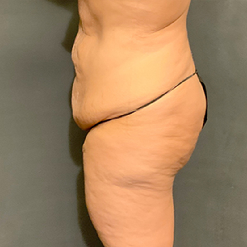 Brazilian Butt Lift 03