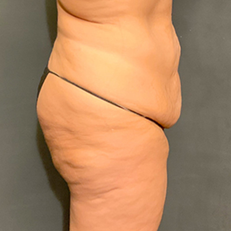 Brazilian Butt Lift 05