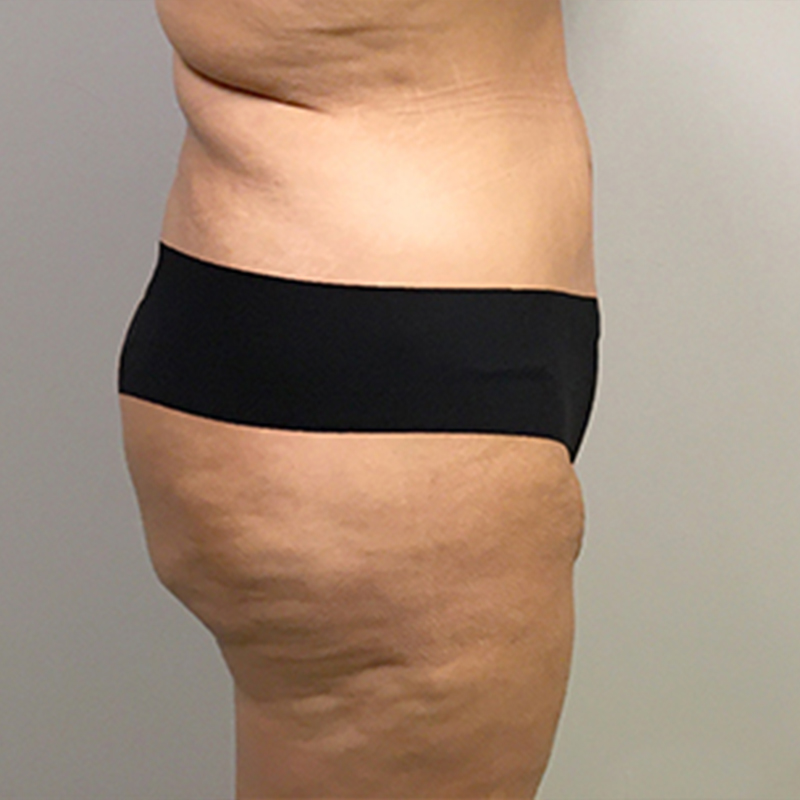 Brazilian Butt Lift 05