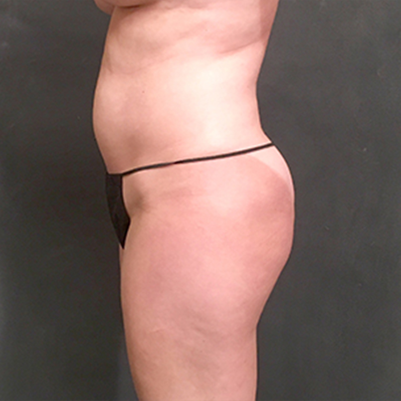 Brazilian Butt Lift 03