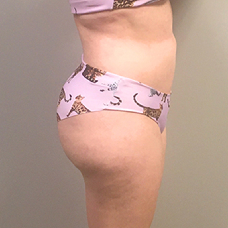 Brazilian Butt Lift 05