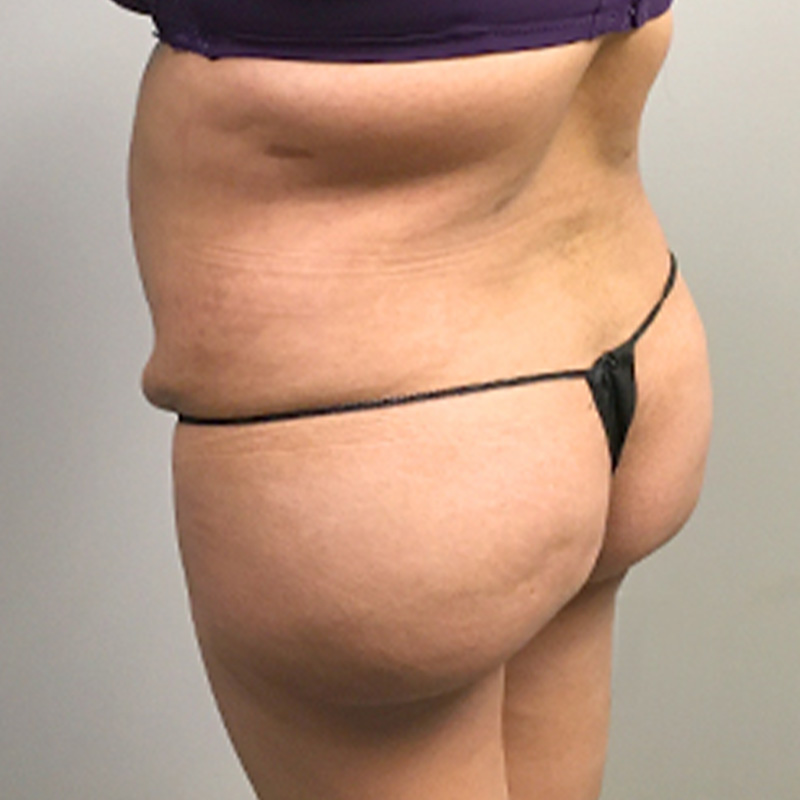 Brazilian Butt Lift 03