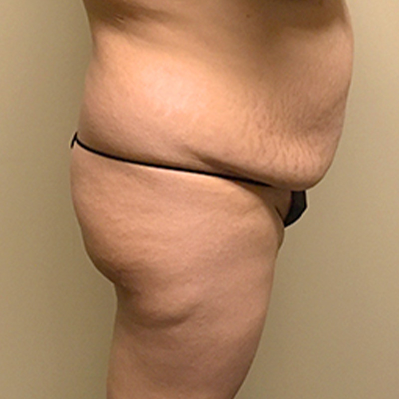 Brazilian Butt Lift 09