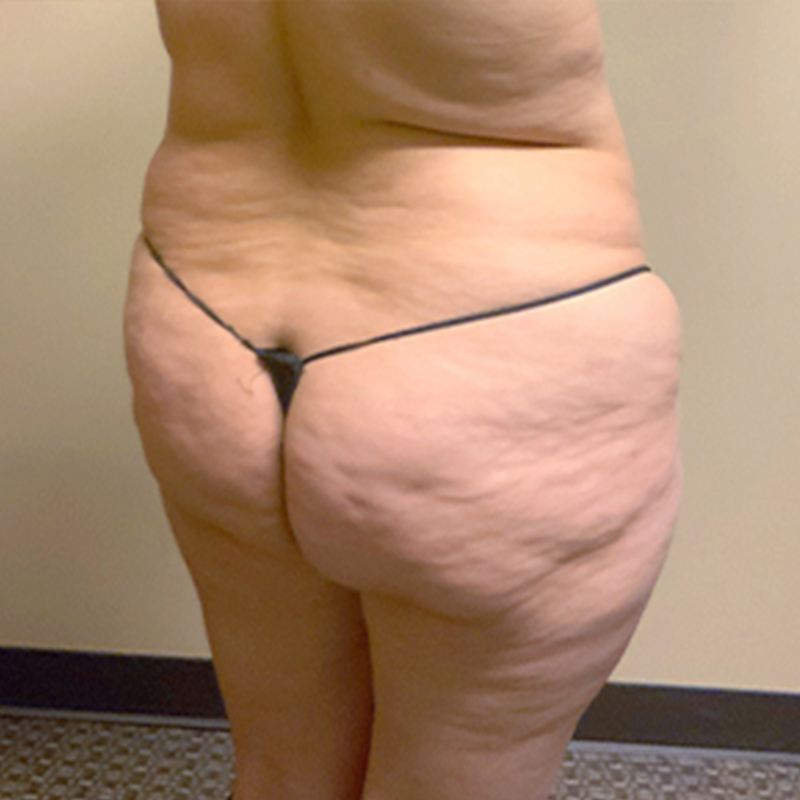 Brazilian Butt Lift 01