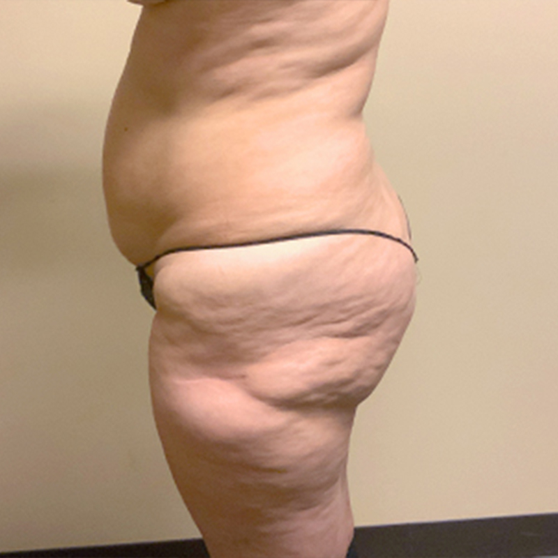 Brazilian Butt Lift 03