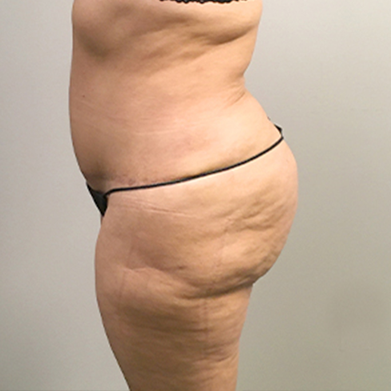 Brazilian Butt Lift 03