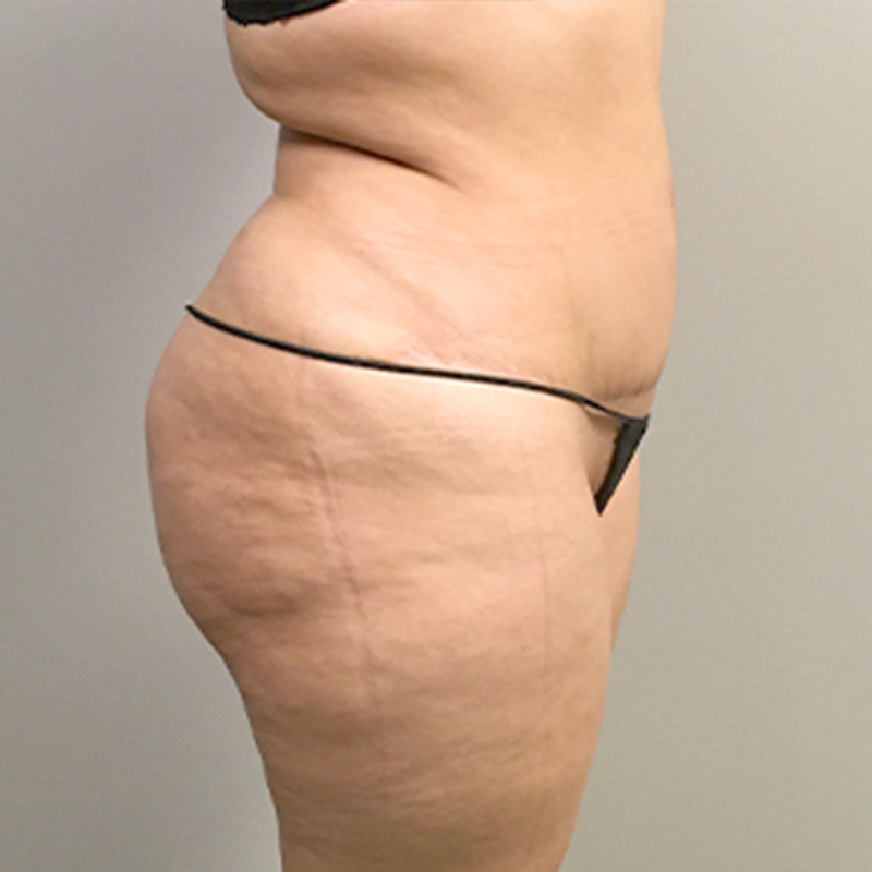 Brazilian Butt Lift 05