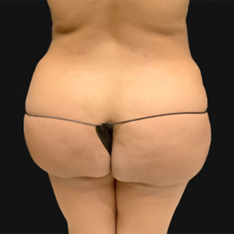 Brazilian Butt Lift 01