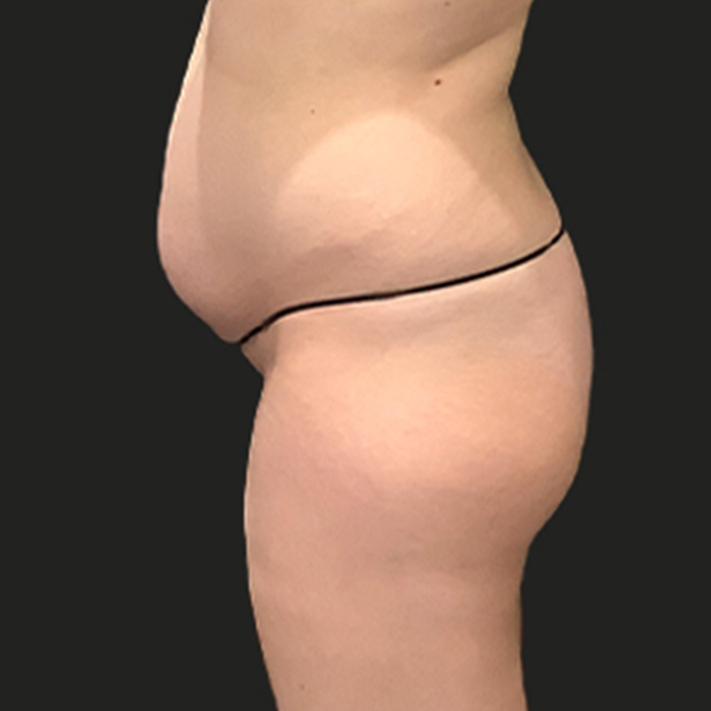 Brazilian Butt Lift 03