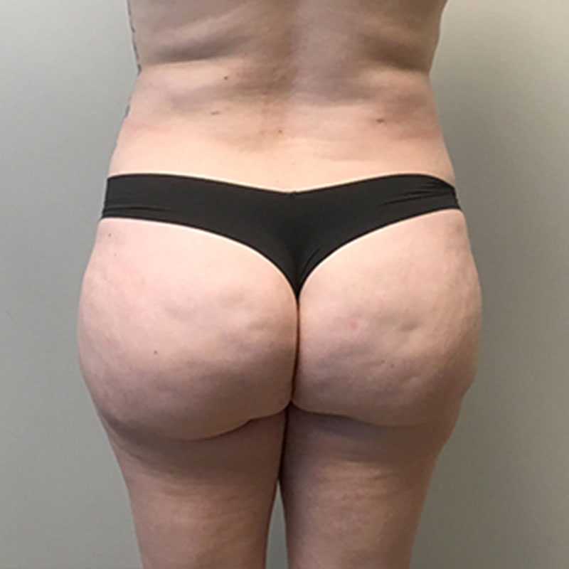 Brazilian Butt Lift 36