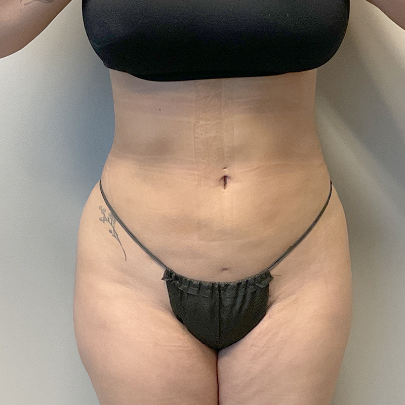 Brazilian Butt Lift 05