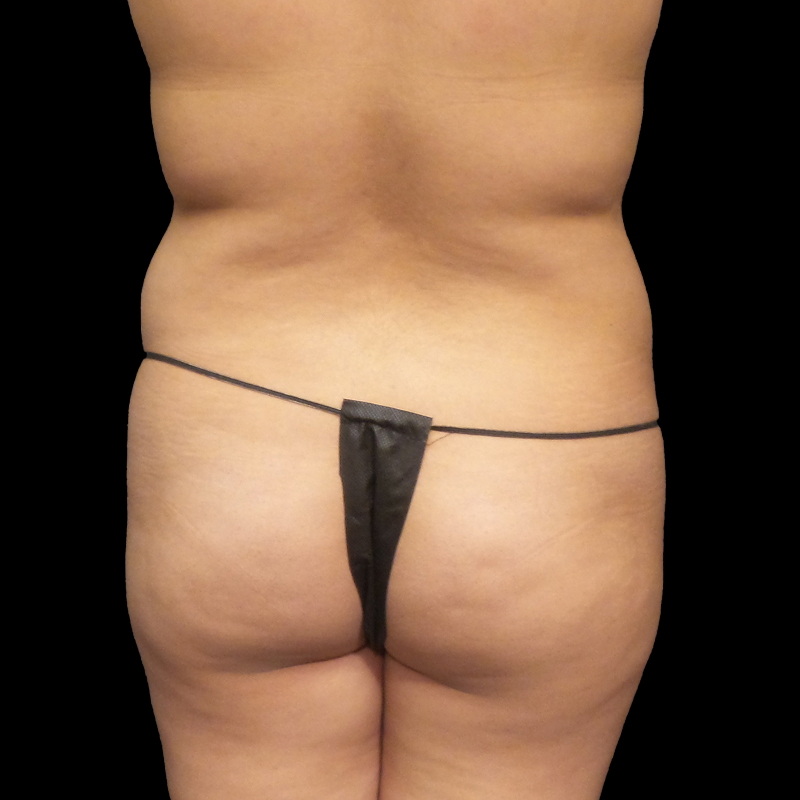 Brazilian Butt Lift 03