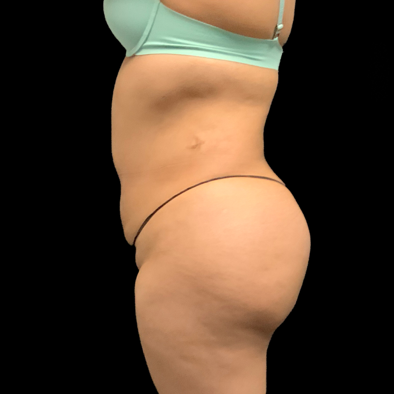 Brazilian Butt Lift 05