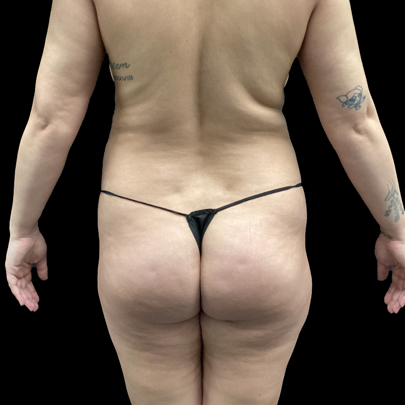 Brazilian Butt Lift 01