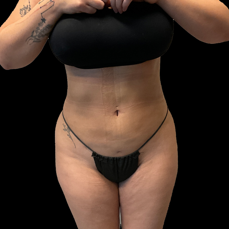 Brazilian Butt Lift 03