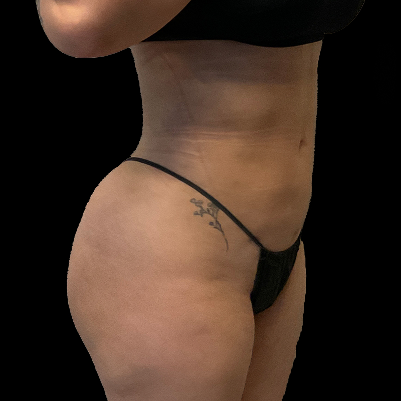 Brazilian Butt Lift 05