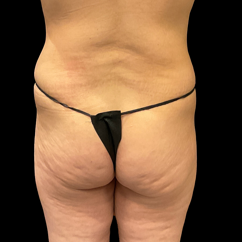 Brazilian Butt Lift 01