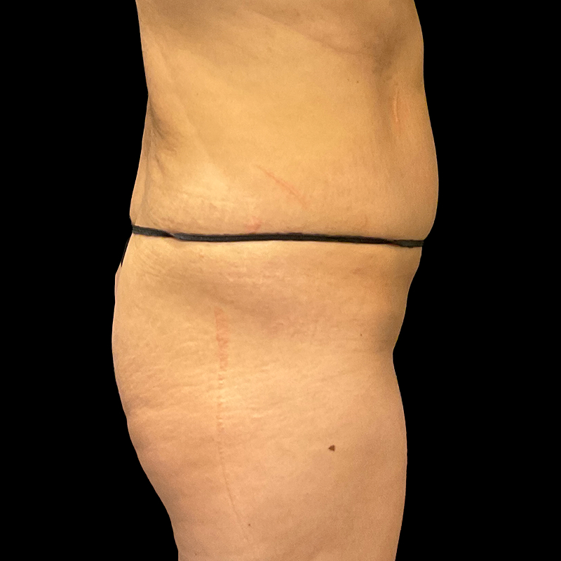 Brazilian Butt Lift 05