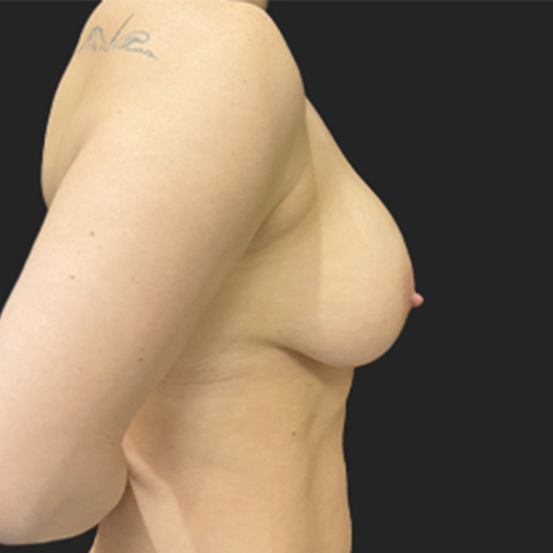 Breast Augmentation Revision 05