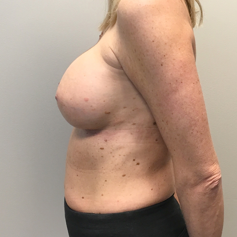 Breast Augmentation Revision 03