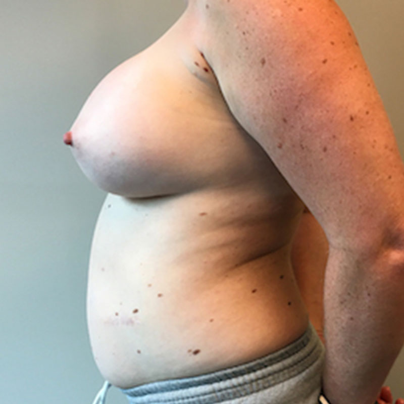 Breast Augmentation Revision 07