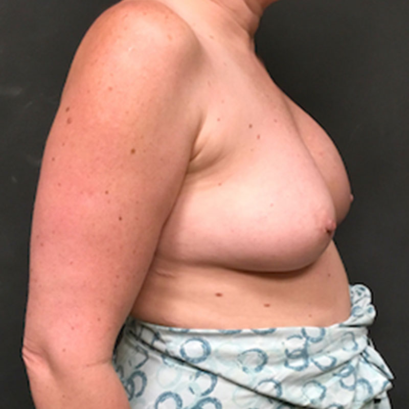 Breast Augmentation Revision 09