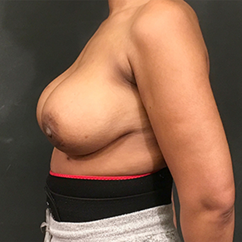 Breast Augmentation Revision 05