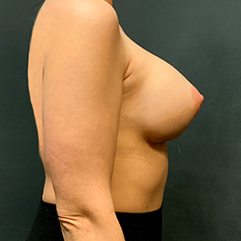 Breast Augmentation Revision 07