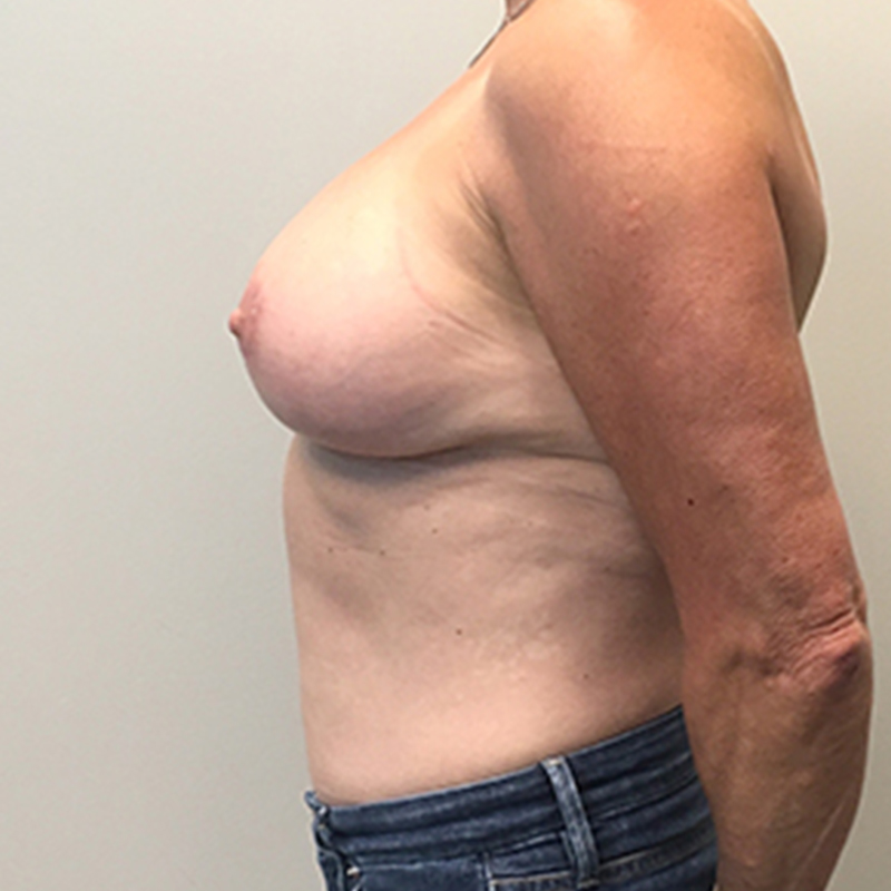 Breast Augmentation Revision 05