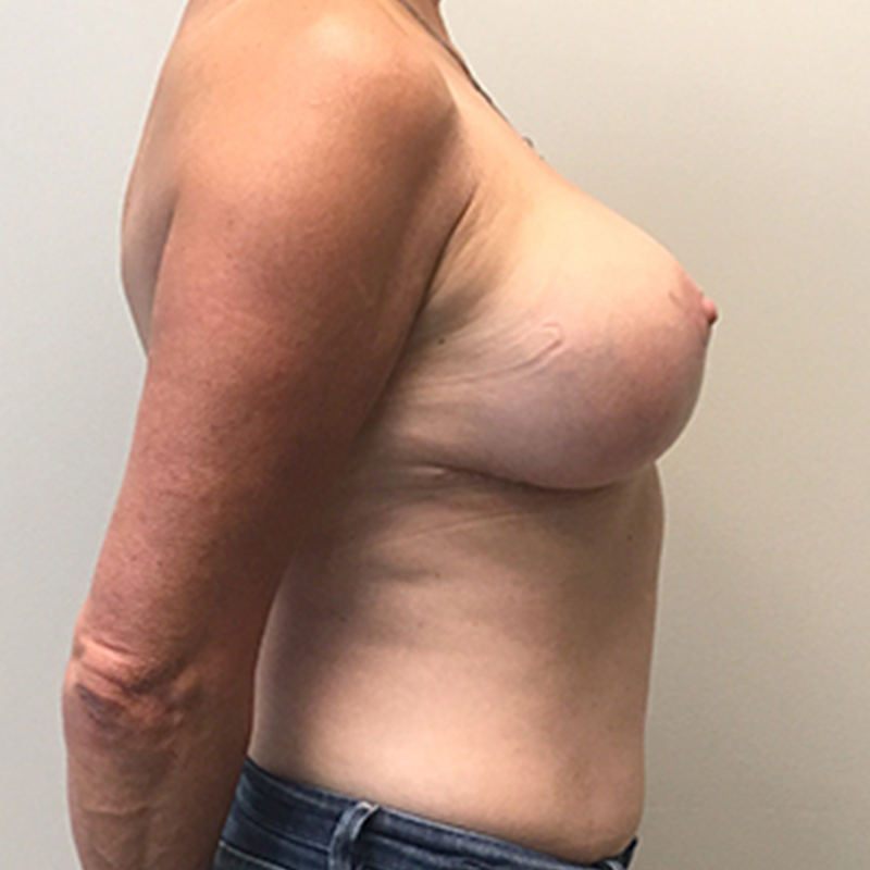 Breast Augmentation Revision 09