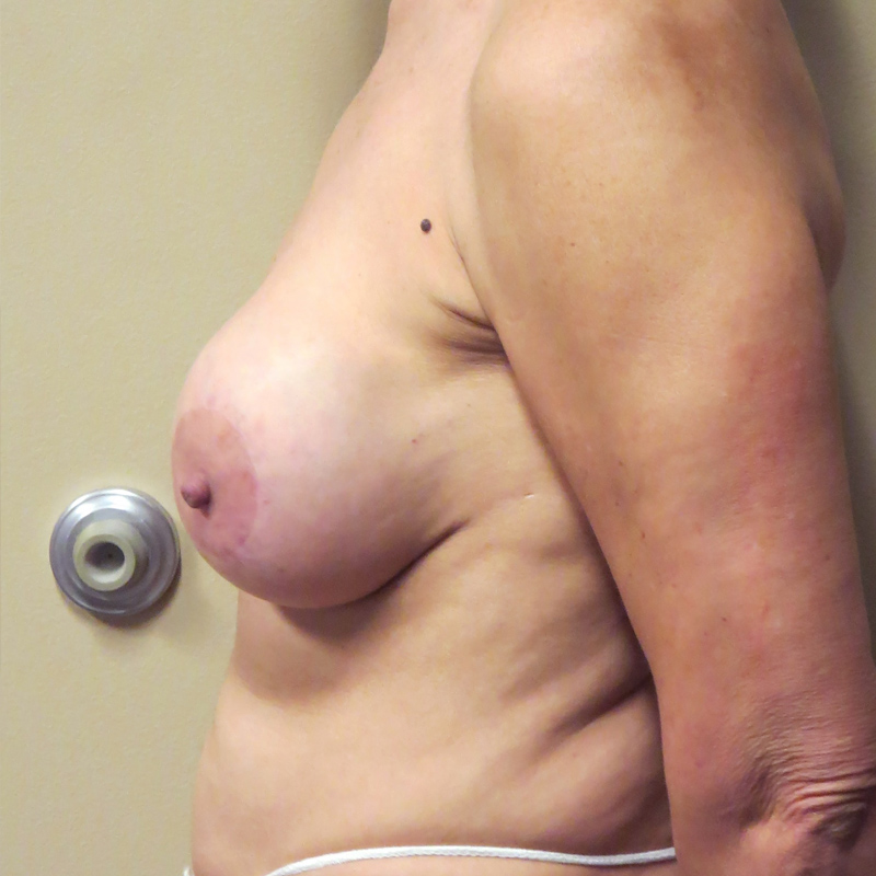 Breast Augmentation Revision 05