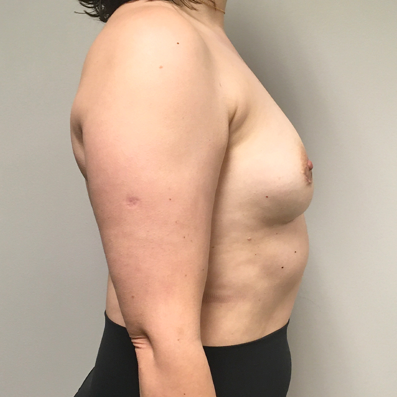 Breast Augmentation Revision 05