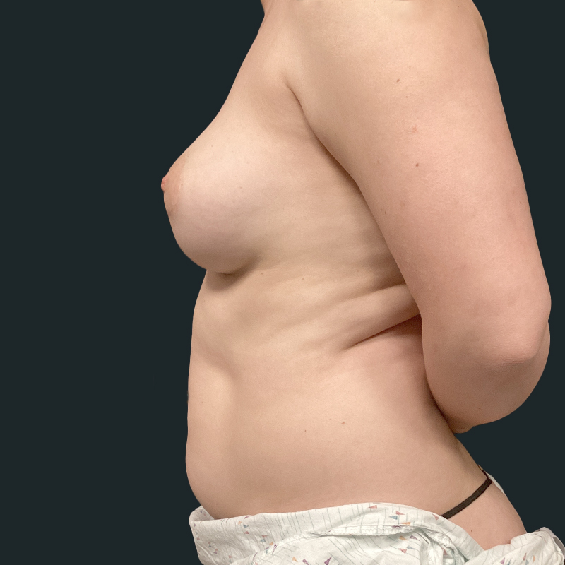 Breast Augmentation Revision 07