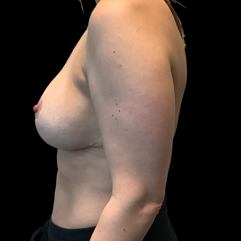 Breast Augmentation Revision 03