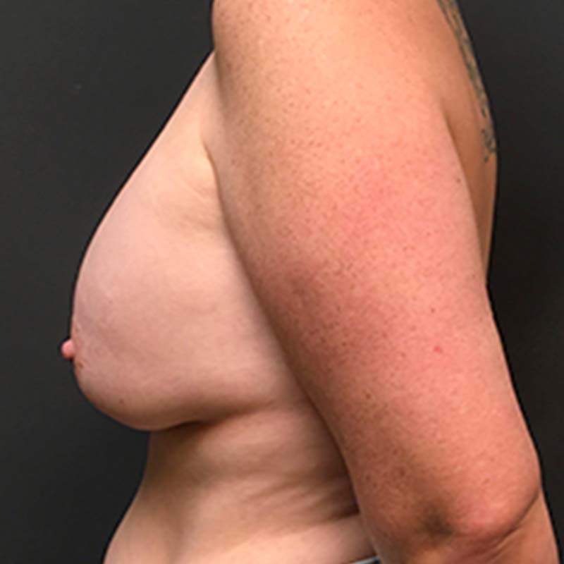 Breast Augmentation With Lift 03