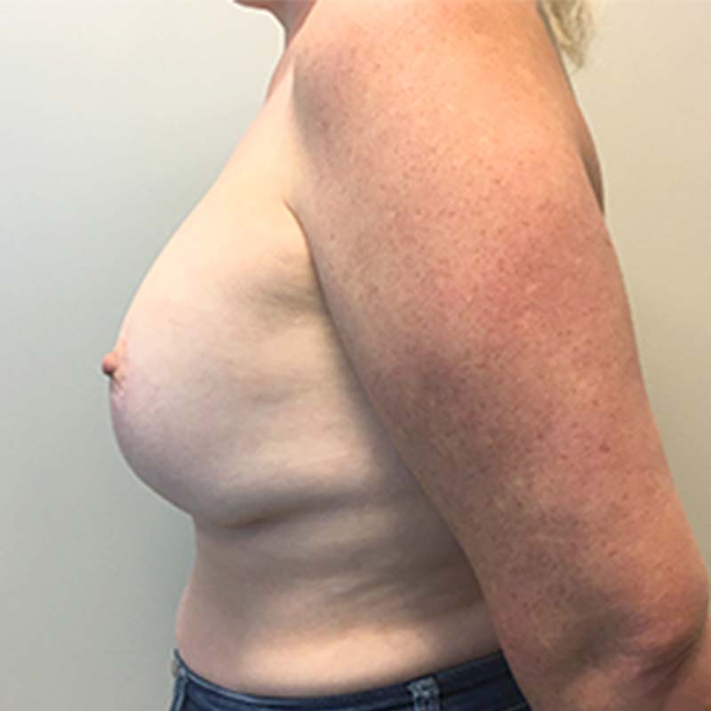 Breast Augmentation With Lift 03