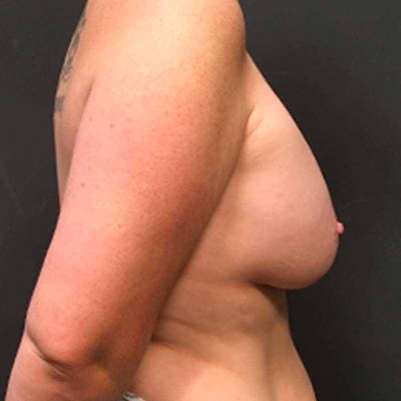 Breast Augmentation With Lift 07