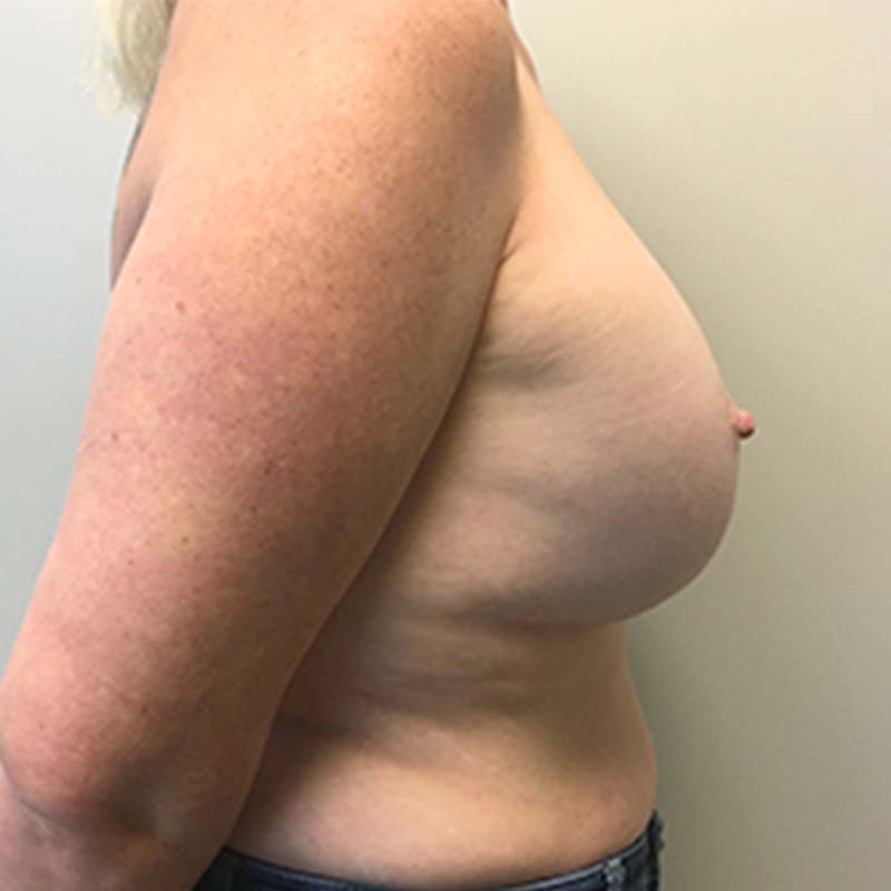 Breast Augmentation With Lift 07