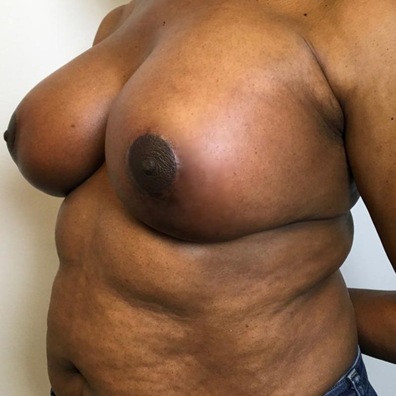 Breast Augmentation With Lift 03