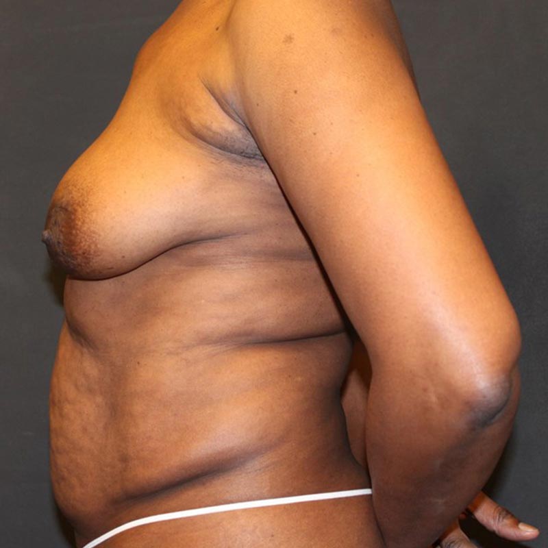 Breast Augmentation With Lift 05