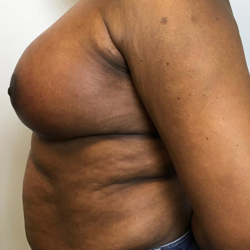 Breast Augmentation With Lift 05