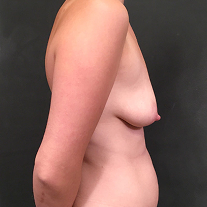 Breast Augmentation With Lift 07
