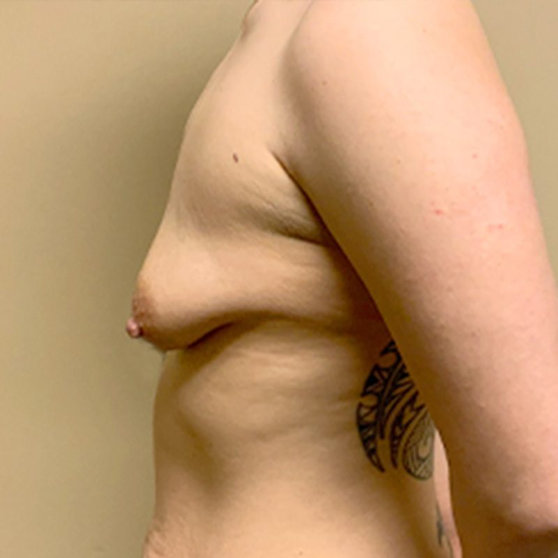 Breast Augmentation With Lift 03