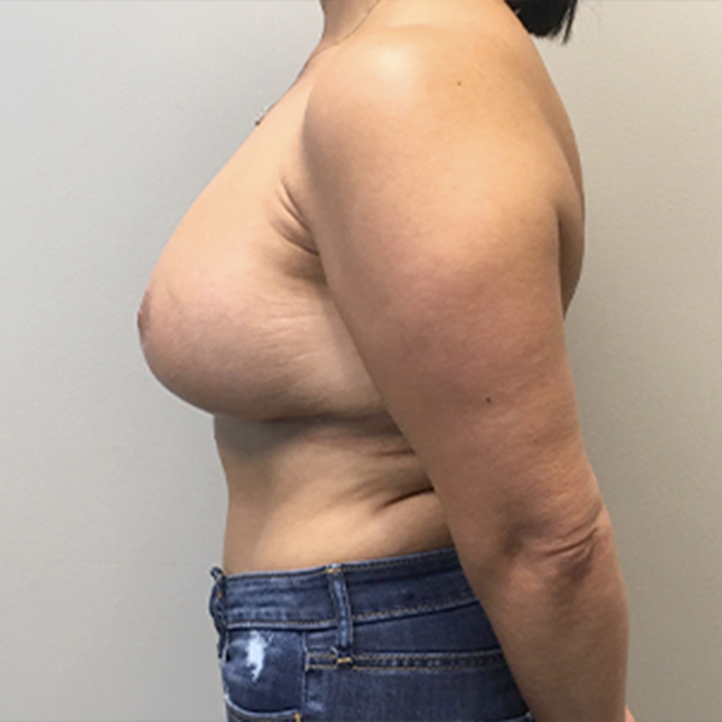 Breast Augmentation With Lift 05