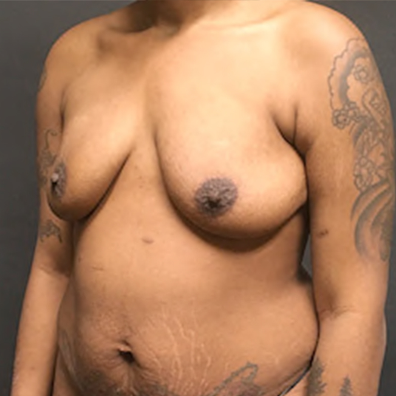 Breast Augmentation With Lift 03