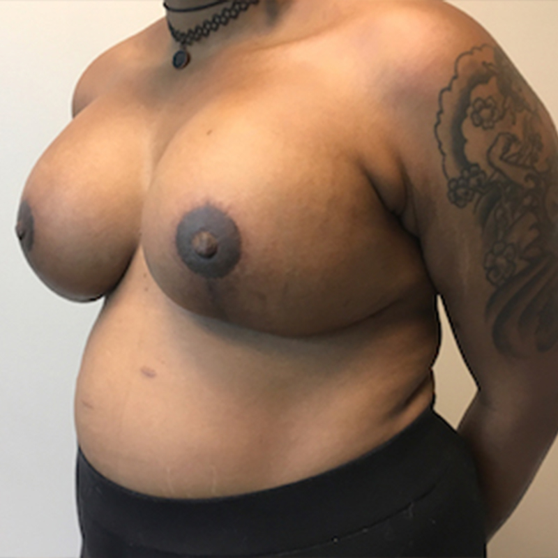 Breast Augmentation With Lift 03